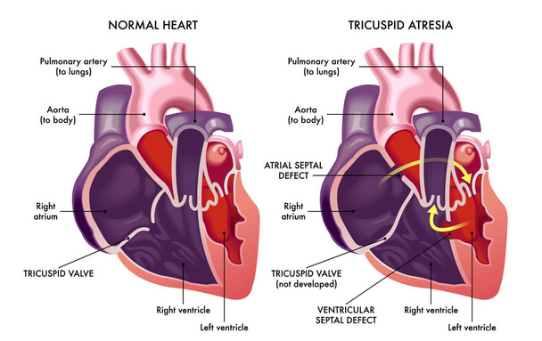 Ilustração médica comparando coração normal com coração acometido por defeitos de atresia tricúspide - Vetor, Imagem
