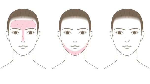 Un luogo sul viso in cui l'acne è probabile che si verifichi. - Vettoriali, immagini