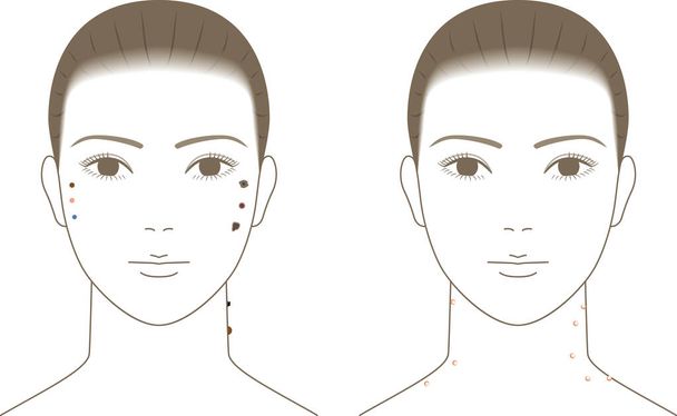 Kobieta z pieprzykami i kurzajkami na twarzy i szyi - Wektor, obraz