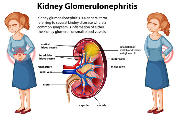 Lékařská infografika ledvinové glomerulosklerózy ilustrace - Vektor, obrázek