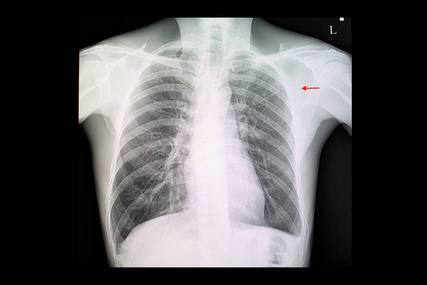Рентгеновская пленка грудной клетки пациента с туберкулезом легких с фибромодулярной инфильтрацией в левом верхнем лёгком. - Фото, изображение