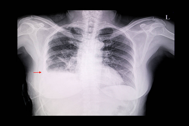 Een röntgenfoto van de borst van een vrouwelijke patiënt met cardiomegalie, longoedeem en rechter longpleurale effusie. - Foto, afbeelding