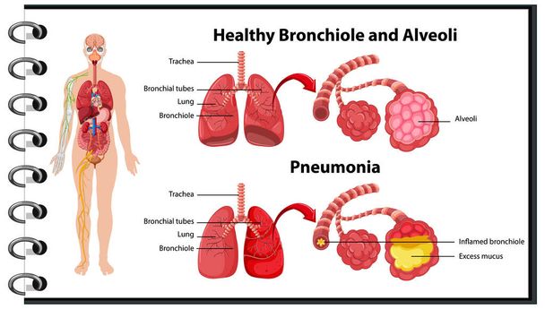 Gezond en ongezond van menselijke longen illustratie - Vector, afbeelding