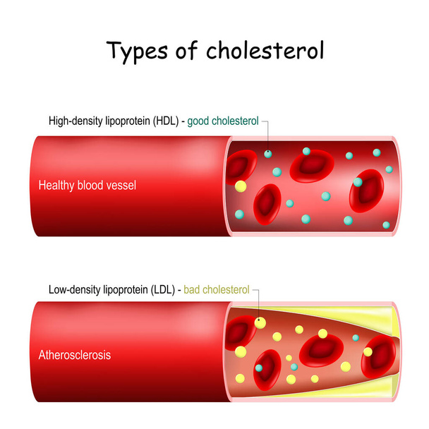 Kolesterolityypit. hyvä (HDL) ja huono (LDL) kolesteroli. Terveet verisuonet ja ateroskleroosi. Verisuonen poikkileikkaus erytrosyyttien, matalan tiheyden ja tiheän lipoproteiinin kanssa. Vektori kaavio Normaali ja kaventunut valtimo selityksiä - Vektori, kuva