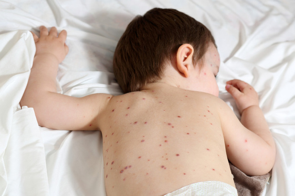 La varicelle et le bébé
 - Photo, image