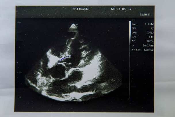 Imagem do ultra-som cardíaco com perigo para a saúde impresso em papel. - Foto, Imagem