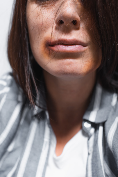 家庭内暴力の犠牲者の顔に打撲傷の作物ビュー  - 写真・画像