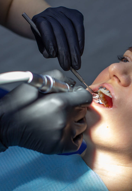 Μια γυναίκα σε ραντεβού οδοντιάτρου να αντικαταστήσει τις καμάρες με σιδεράκια. - Φωτογραφία, εικόνα