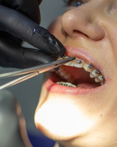Žena u zubaře, která má nahradit oblouky rovnátky.. - Fotografie, Obrázek