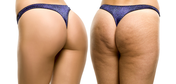 Nalgas femeninas antes y después sobre fondo blanco - Foto, Imagen