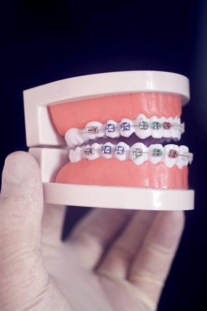 歯科歯アライナーブラケット歯茎や金属歯の矯正器を示す学生モデルを教える. - 写真・画像