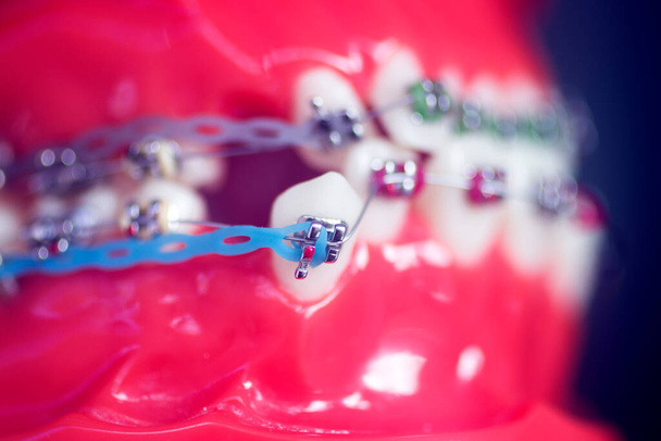 Soporte de alineador de dientes dentales modelo de enseñanza de estudiantes que muestra encías y alisadores de dientes de metal. - Foto, Imagen