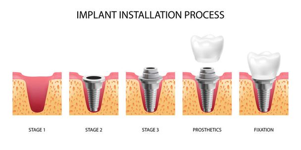 Etapy montażu implantów - Wektor, obraz