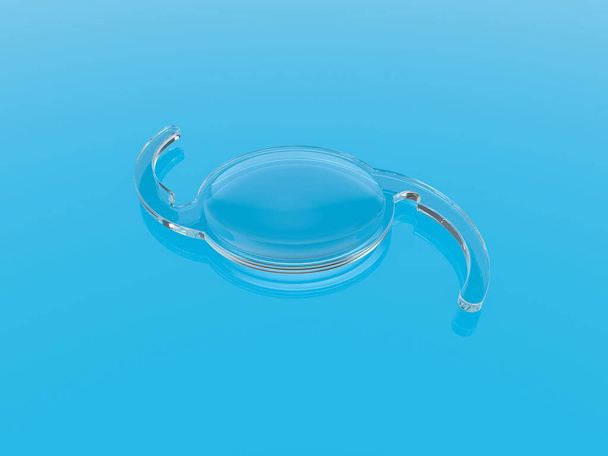 lente intraocular iol catarata oftalmología  - Foto, imagen