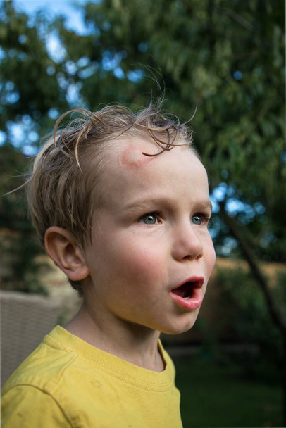 Κόκκινο και άσπρο καρούμπαλο στο μέτωπο ενός μικρού παιδιού. Πόνος, μώλωπας, ατύχημα, προβλήματα, παιδική ηλικία. Κοντινό πορτραίτο - Φωτογραφία, εικόνα
