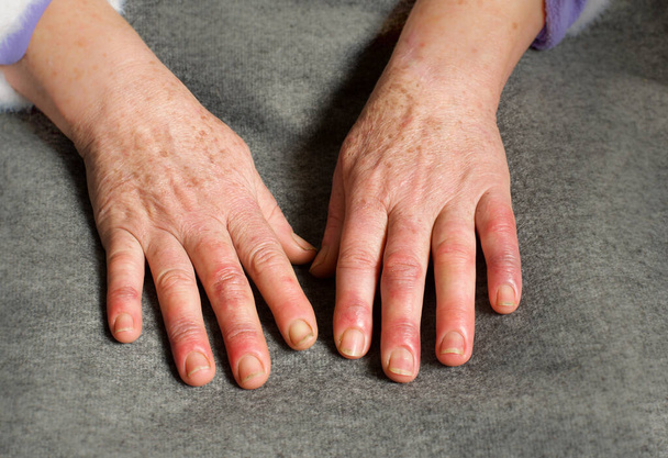  Hands of a 60-year-old woman with Raynaud's syndrome - Photo, Image
