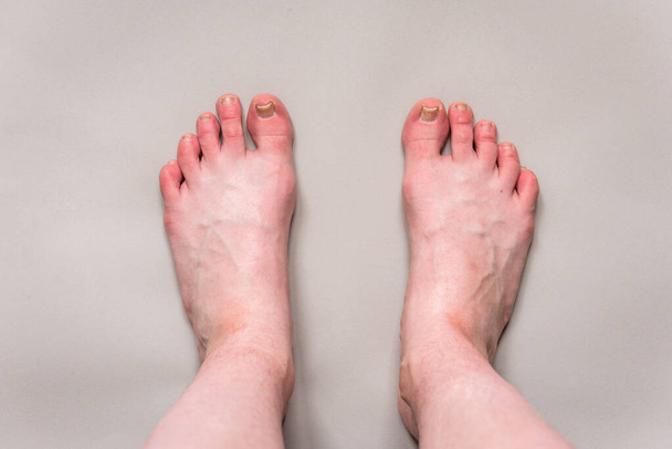 Damaged toenail on big toe on gray background. Callus on foot. - Φωτογραφία, εικόνα