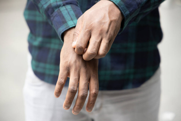 Man scratching suffering from itching hand skin; sick African man scratching his skin with allergy, rash, ringworm, tinea problem; skin care, dermatology concept; adult black African man model - Photo, Image