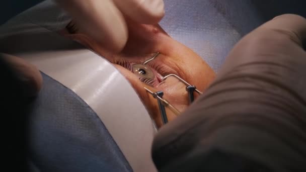 Laserzicht correctie. Een patiënt en een team chirurgen in de operatiekamer tijdens oogheelkundige chirurgie. Ooglidspeculum. Lasik behandeling. Patiënt onder steriele dekking - Video