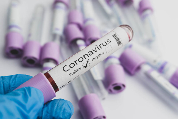 Muestras de análisis de sangre para detectar la presencia de un tubo de coronavirus (COVID-19) que contiene una muestra de sangre que ha dado positivo en coronavirus. Concepto Covid-19. - Foto, Imagen