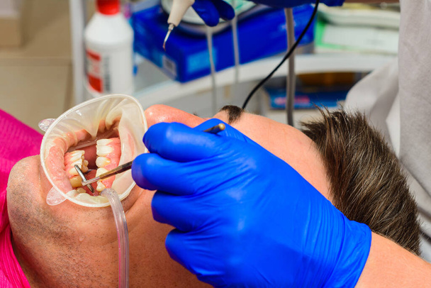paziente rimuovere tartaro, il dentista utilizza gli ultrasuoni per rimuovere tartaro, scalatore dentale.2020 - Foto, immagini
