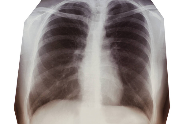 Keuhkojen röntgenkuva keuhkokuumeesta. Coronavirus, Covid-19. - Valokuva, kuva