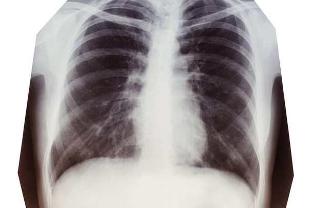 Ακτινογραφία των πνευμόνων με πνευμονία. Coronavirus, Covid-19. - Φωτογραφία, εικόνα