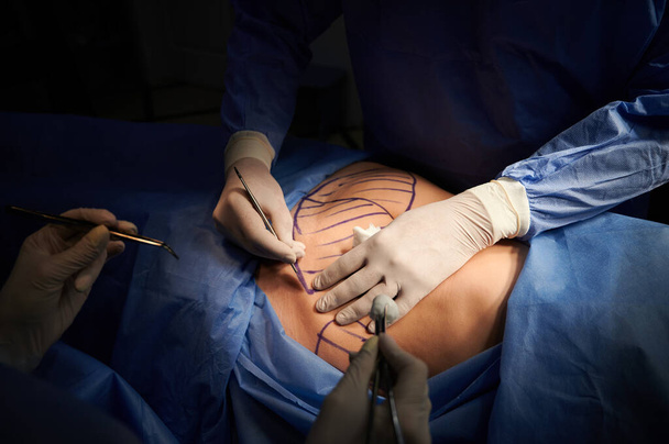 Close up of plastic surgeon hands in gloves using scalpel while doing plastic surgery in clinic. Patient with marks on belly lying on operating table. Concept of cosmetic surgery and abdominoplasty. - Φωτογραφία, εικόνα