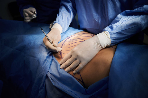 Close up surgeon hands in white sterile gloves using scalpel, doing plastic surgery in operating room. Surgeon cutting patient belly with blue marks on skin. Concept of medicine and abdominoplasty. - Fotoğraf, Görsel