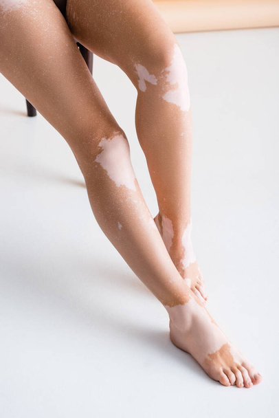 cropped view of female legs with vitiligo on white background - Fotoğraf, Görsel