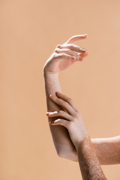 bijgesneden weergave van vrouwelijke handen met vitiligo geïsoleerd op beige - Foto, afbeelding