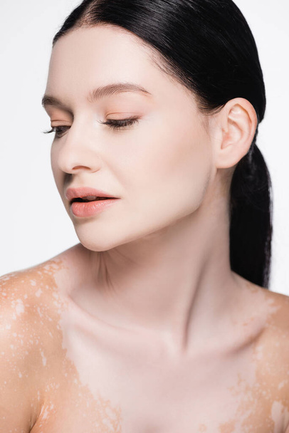 retrato de jovem bela mulher com vitiligo isolado em branco - Foto, Imagem