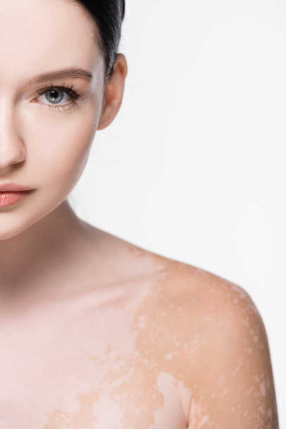 portrait of young beautiful woman with vitiligo isolated on white - Zdjęcie, obraz