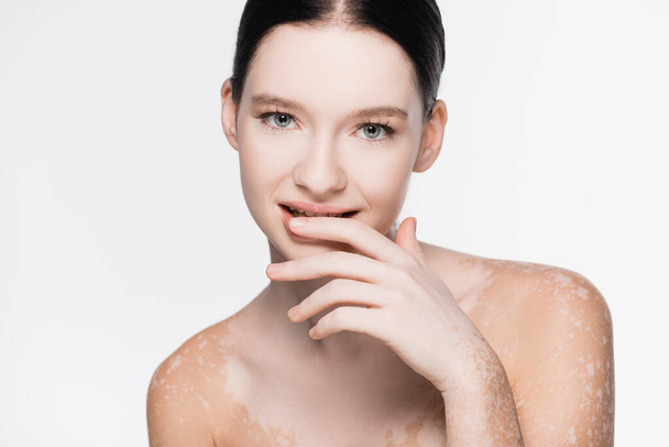 joven hermosa mujer con vitiligo aislado en blanco - Foto, Imagen