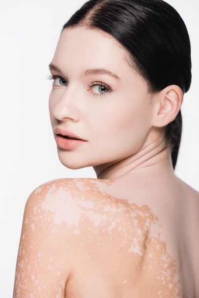 mladá krásná žena s vitiligo izolované na bílém - Fotografie, Obrázek