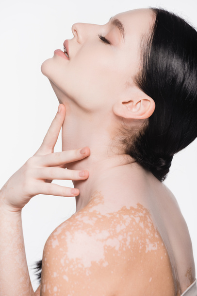 oldalnézetben fiatal gyönyörű nő vitiligo elszigetelt fehér - Fotó, kép