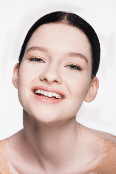sourire jeune belle femme avec vitiligo isolé sur blanc - Photo, image