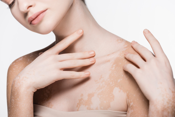 recortado vista de joven hermosa mujer con vitiligo aislado en blanco - Foto, imagen