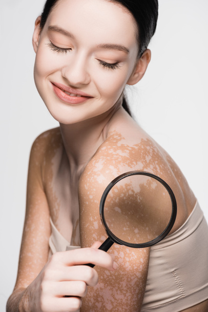 usmívající se mladá krásná žena s vitiligo drží lupu izolované na bílém - Fotografie, Obrázek
