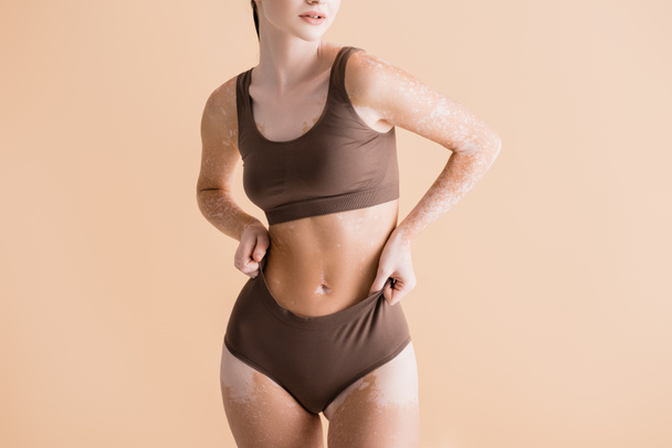 vue recadrée de jeune belle femme avec vitiligo posant en sous-vêtements isolés sur beige - Photo, image