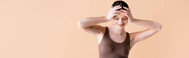usmívající se mladá krásná žena s vitiligem pózující ve spodním prádle izolované na béžové, banner - Fotografie, Obrázek