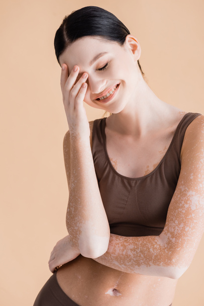 sorrindo jovem bela mulher com vitiligo posando em roupa interior isolado no bege - Foto, Imagem