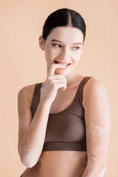 young beautiful woman with vitiligo posing in underwear isolated on beige - Фото, зображення