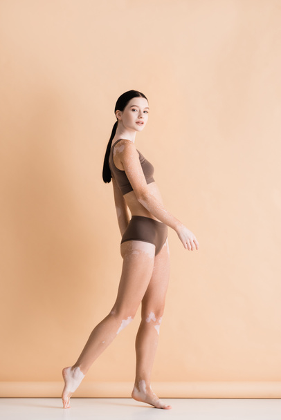 side view of young beautiful woman with vitiligo posing in underwear on beige - Фото, зображення