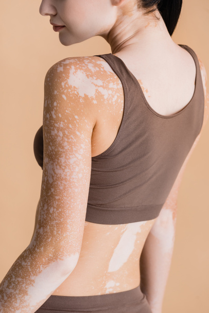cropped view of young beautiful woman with vitiligo isolated on beige - Photo, Image
