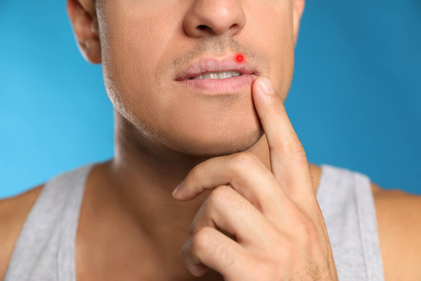 Man with herpes touching lip against light blue background, closeup - Foto, imagen