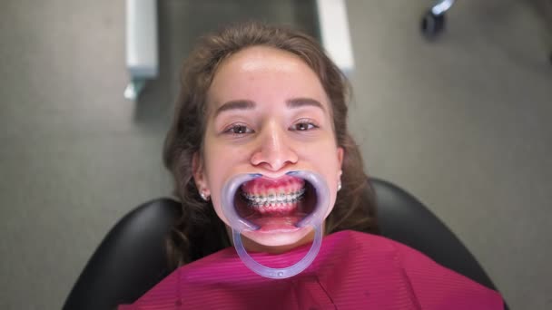 Fiatal nő beteg Retractor a szájban fogszabályzóval a fogorvosi rendelőben fekszik a kórházban ágy és vár a fogorvos. Egészségügyi és Orvosi Koncepció. Közelről. Portré. - Felvétel, videó