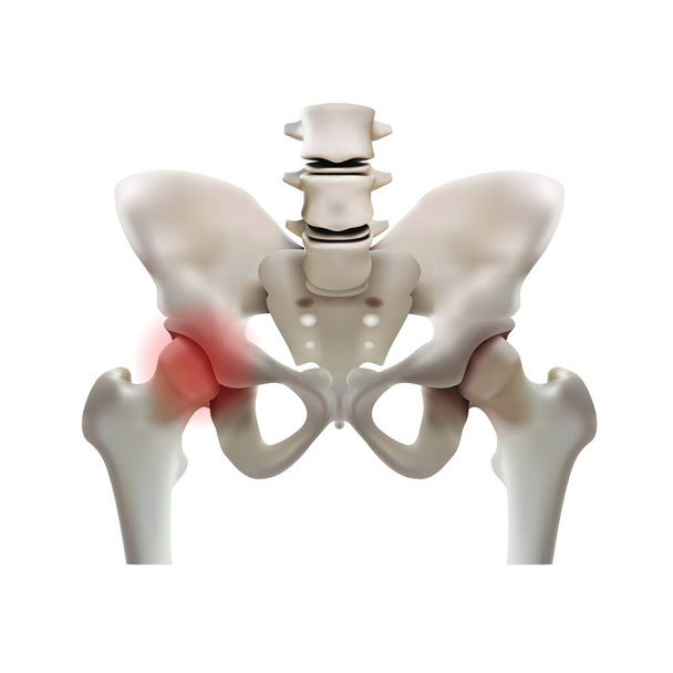 Artritis de la articulación de la cadera sobre un fondo blanco - Vector, Imagen