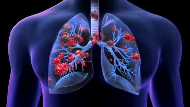Los pulmones contagiados. Animación realista de imágenes 3D del síndrome respiratorio agudo severo coronavirus 2 (SARS-CoV-2) conocido como 2019-nCoV. Novela coronavirus close up. Animación médica de alta calidad. - Metraje, vídeo