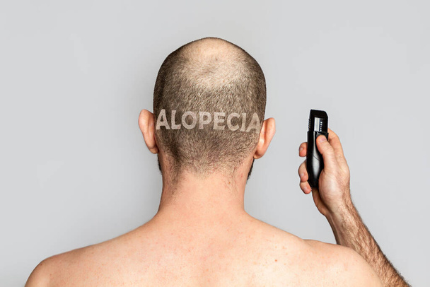 Alopecia masculina. Un hombre con el pelo adelgazado sostiene una máquina de afeitar eléctrica. Vista trasera. Fondo gris. La alopecia inscripción se afeita en la parte posterior de la cabeza. - Foto, imagen